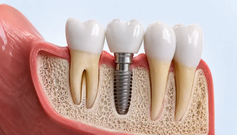 Implante dental en Bormujos - Clinica Silos Seccion de un implante dental de titanio integrado en el hueso con su corona, en Clinica Silos Bormujos