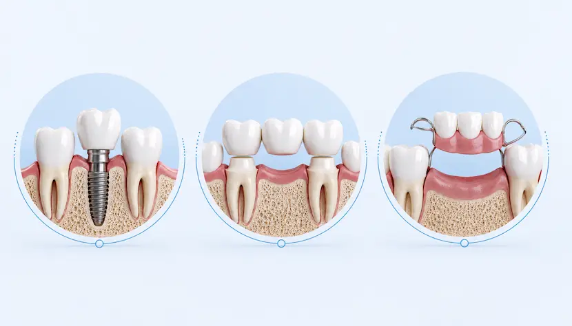 Implante dental frente a puente y protesis Comparativa entre implante dental, puente y protesis removible para reponer un diente