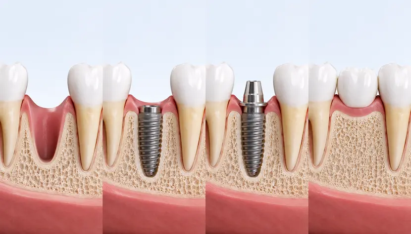 Proceso de un implante dental paso a paso Fases de colocacion de un implante dental paso a paso en Clinica Silos, Bormujos