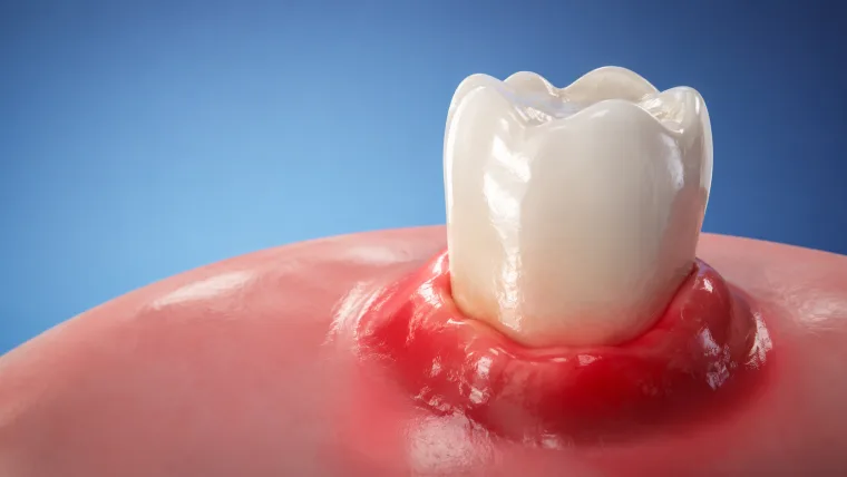 Render de una muela con la encía inflamada por un flemón dental
