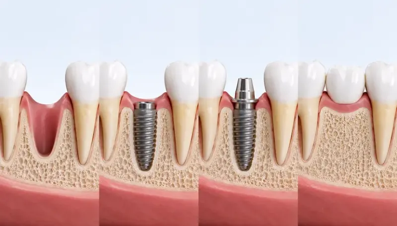 Proceso de un implante dental paso a paso en Bormujos